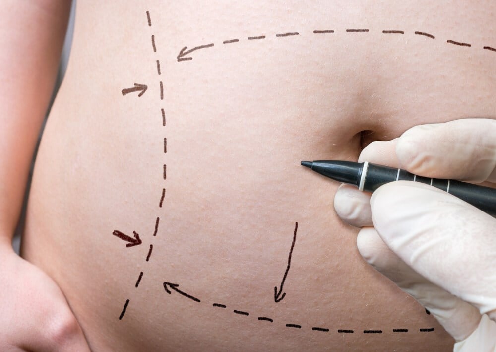 6 Things You Should Do For Your Tummy Tuck Scars and Treatment