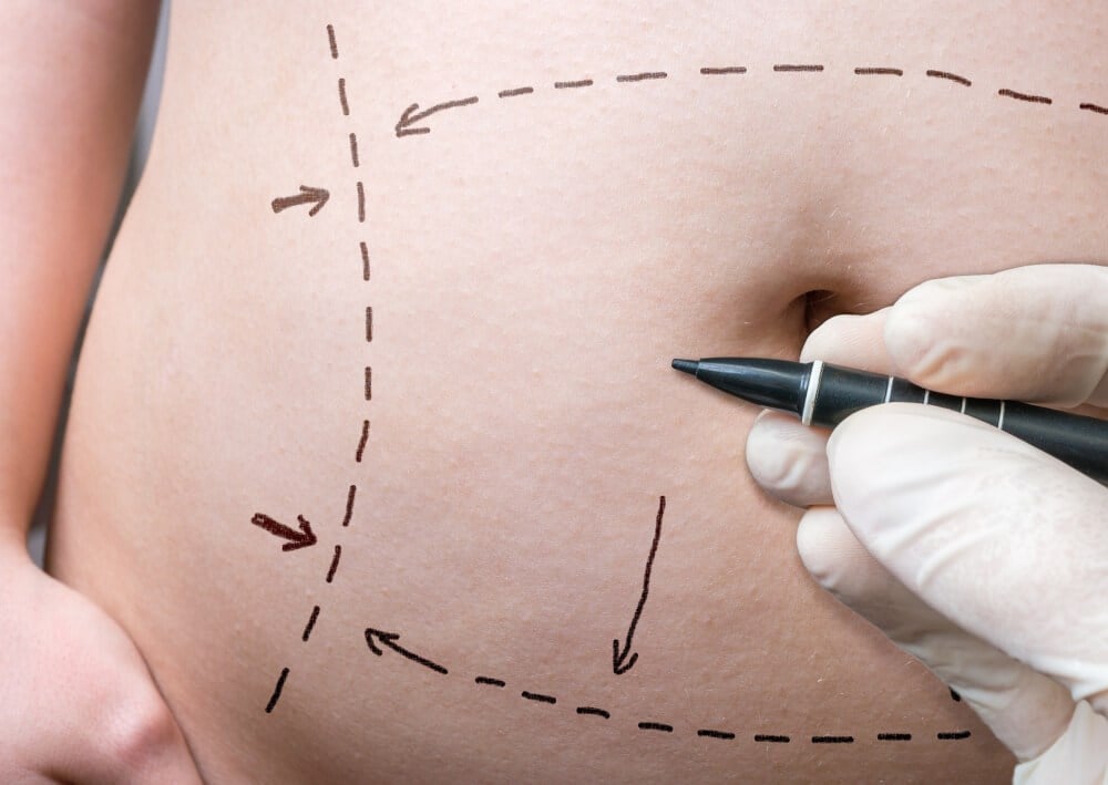 Tummy Tuck Scar: Healing, Treatment & Revision