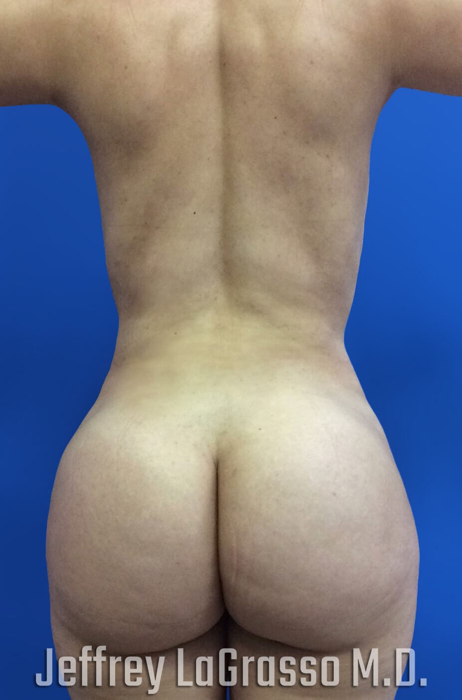 Brazilian Butt Lift After