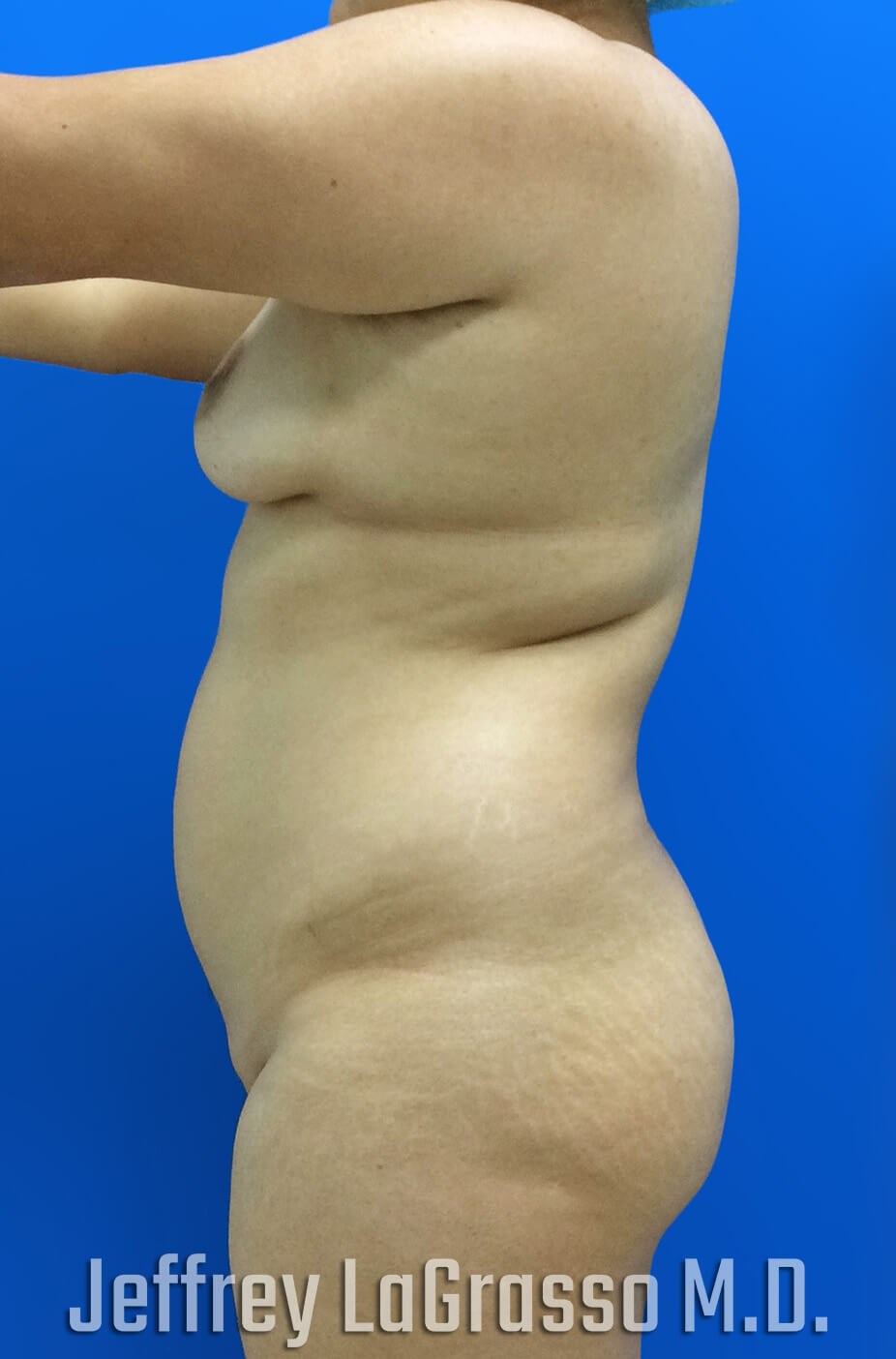 Brazillian Butt Lift Before Lateral View