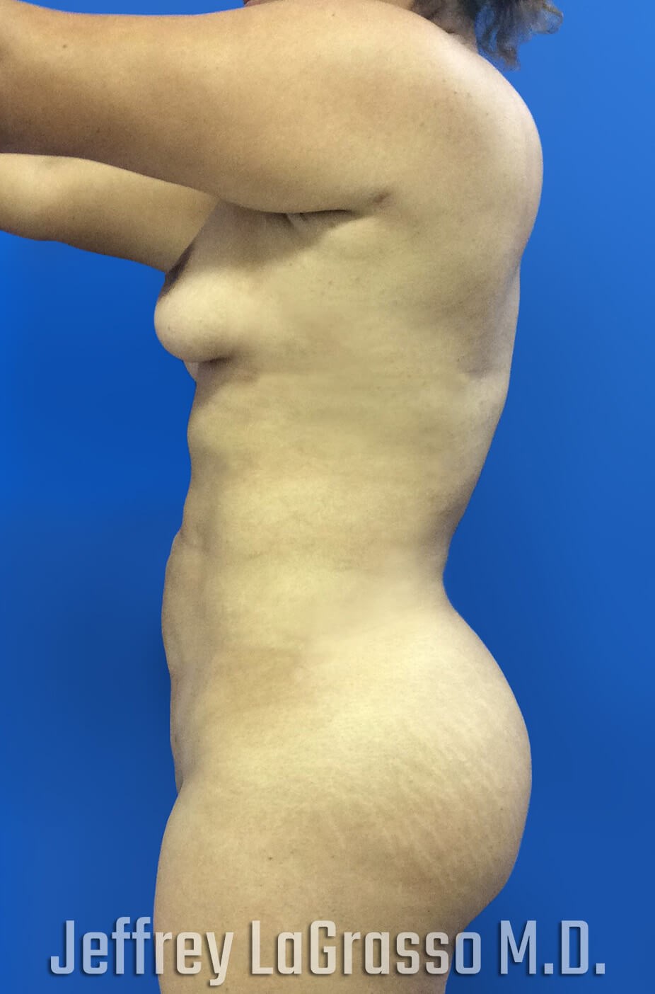 Brazillian Butt Lift After Lateral View