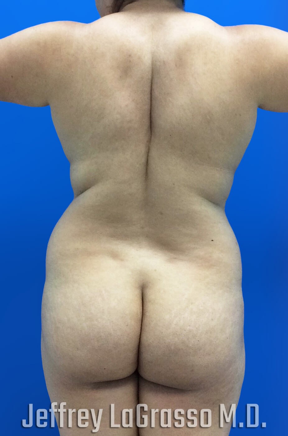 BBL Fat transfer with lipo Before Back View