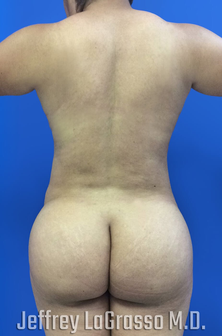 BBL Fat transfer with lipo After back View